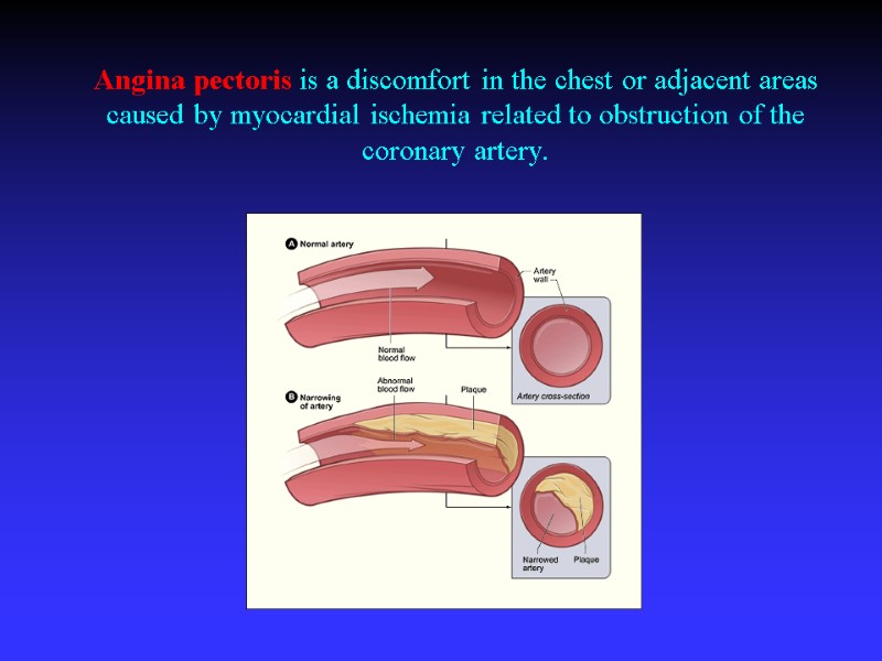 Angina pectoris is a discomfort in the chest or adjacent areas caused by myocardial